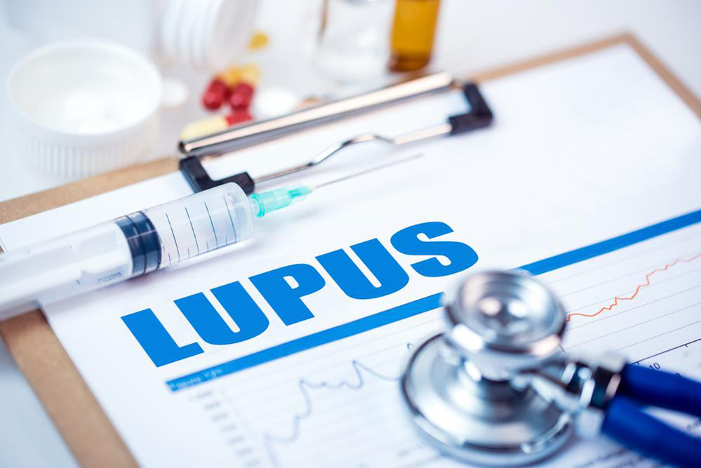 Understanding Lupus: Key Facts and Prevention Tips