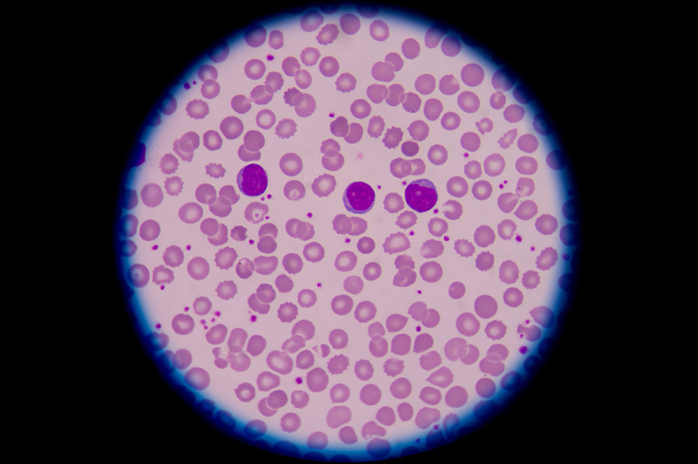 Essential Knowledge About Various Blood Disorders