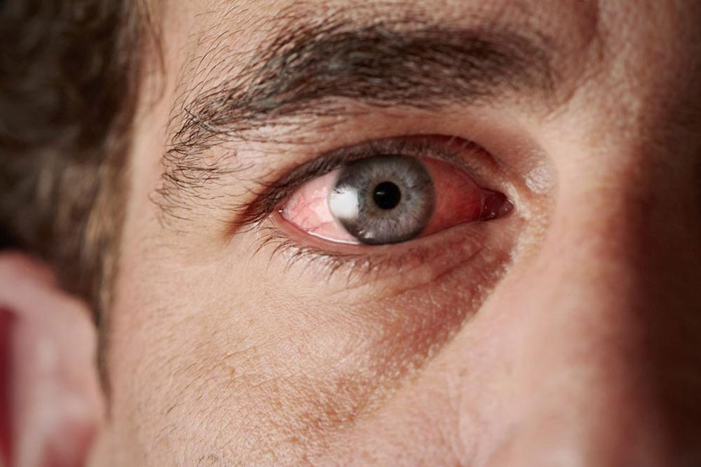 Understanding Sjogren’s Syndrome: Causes and Common Signs