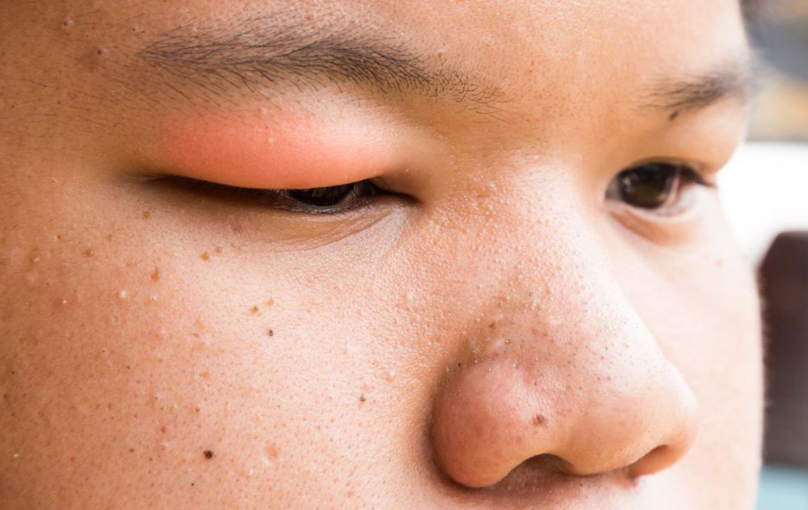 Effective Home Strategies to Eliminate a Stye Quickly