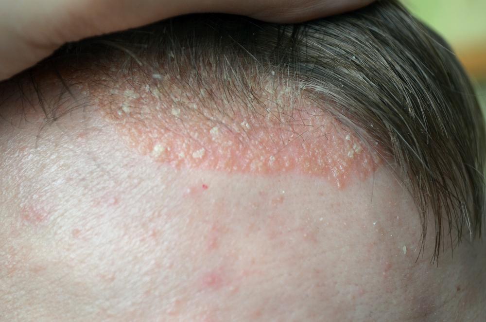 Comprehensive Guide to Managing Scalp Psoriasis