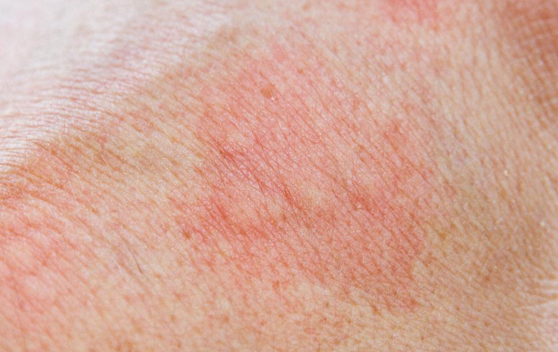Understanding the 5 Common Types of Skin Rashes