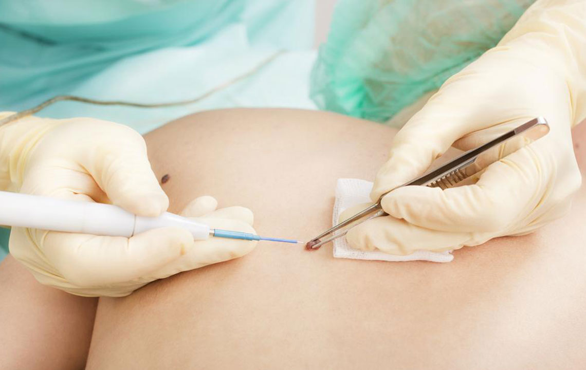 Understanding Common Causes and Signs of Melanoma