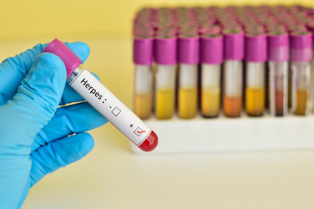 Effective Strategies to Manage and Suppress Herpes Virus