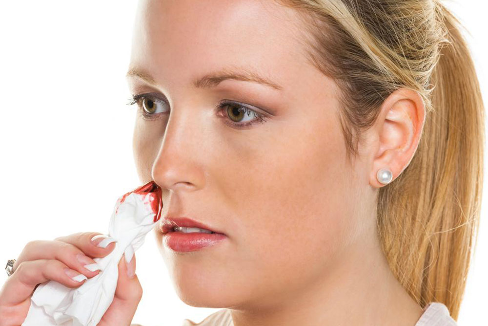 Common Causes of Nosebleeds and When to Seek Medical Help