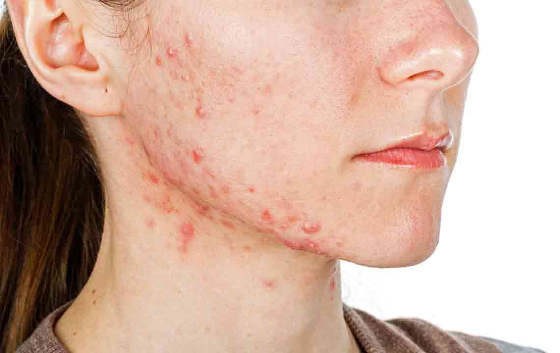 Recognizing Early Symptoms of Lupus: Key Indicators to Watch For