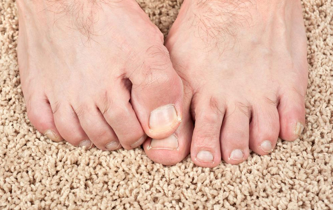 Natural Home Treatments for Nail Fungus Relief