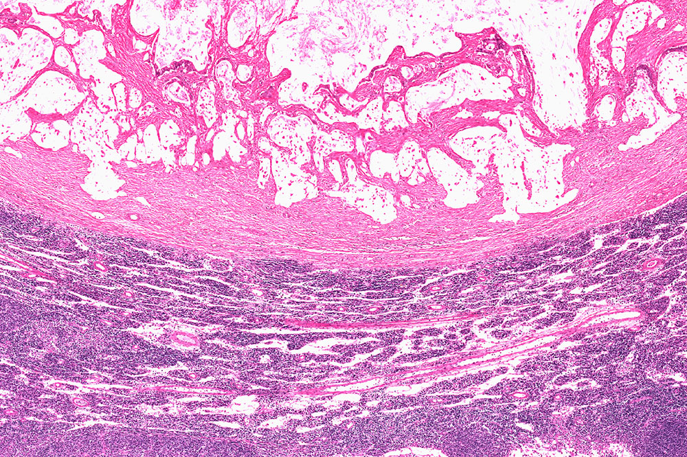 Comprehensive Approaches to Effectively Manage Gastrointestinal Stromal Tumors (GIST)