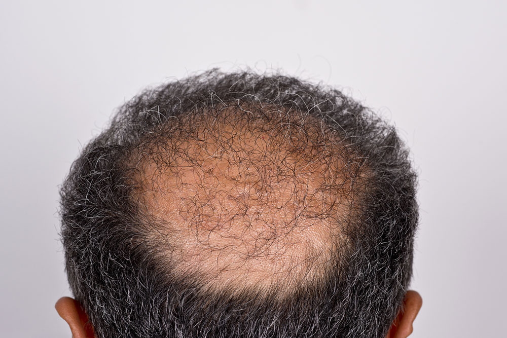 Comprehensive Guide to Hair Restoration: Types, Process, and Pricing