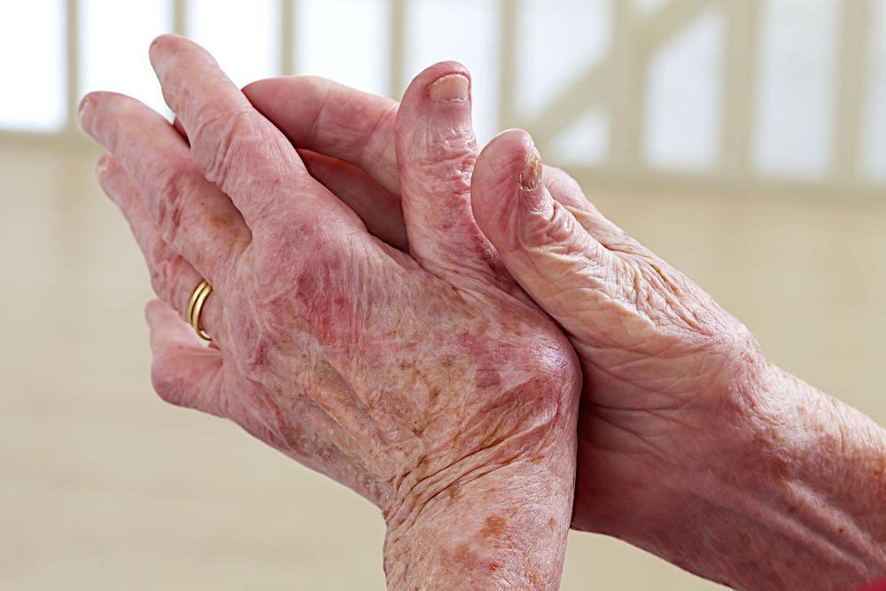Comprehensive Strategies for Managing Lupus