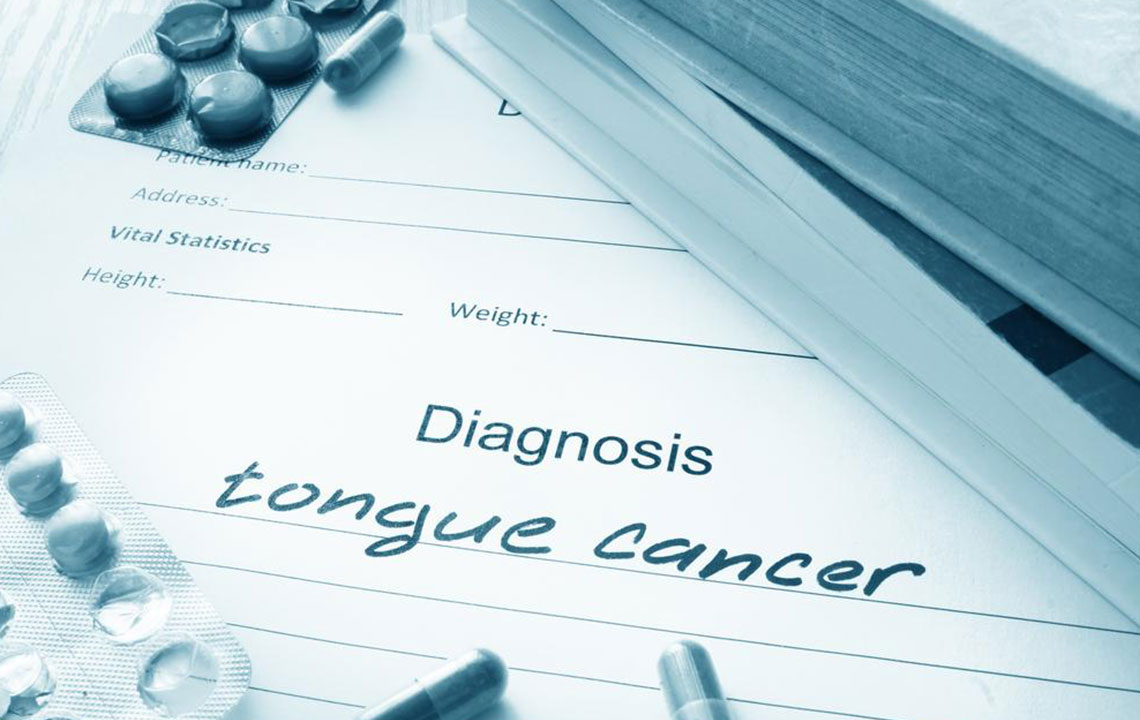 Signs and Symptoms of Tongue Cancer You Should Know