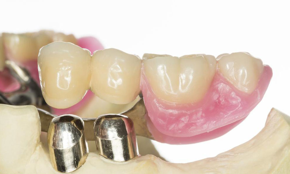 Same-Day Denture Solutions: Benefits and Advantages