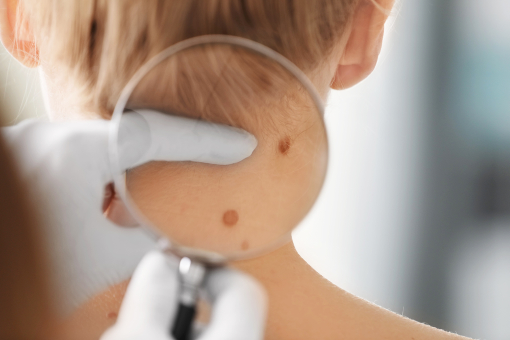 Comprehensive Guide to Melanoma: Early Detection, Diagnosis, and Effective Treatment Options