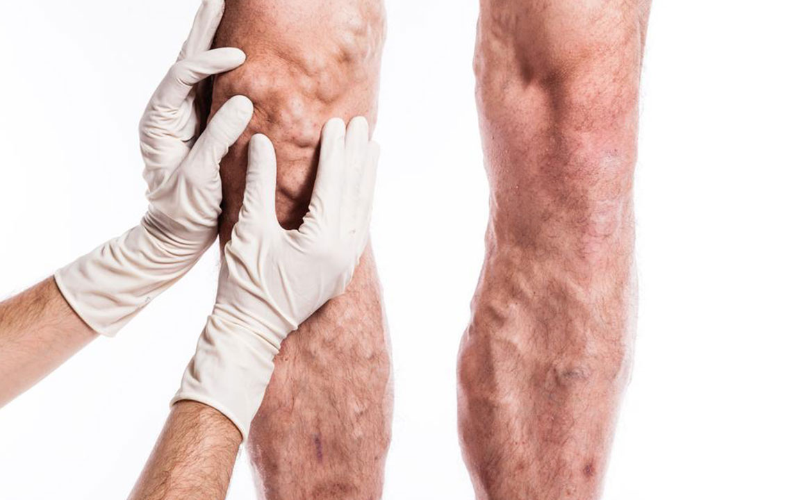 Early Detection of Deep Vein Thrombosis: Key Symptoms and Precautions