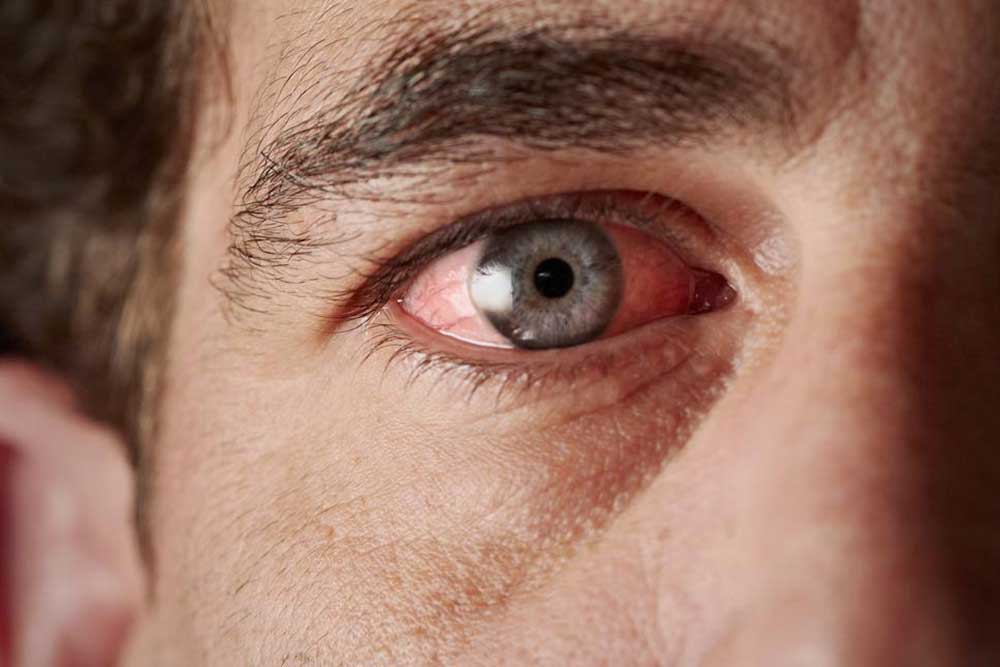 Understanding the Causes and Prevention Strategies for Eye Blood Vessel Breakage