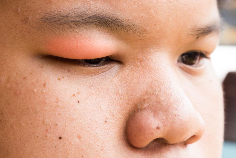 Understanding the Causes and Symptoms of Eyelid Styes