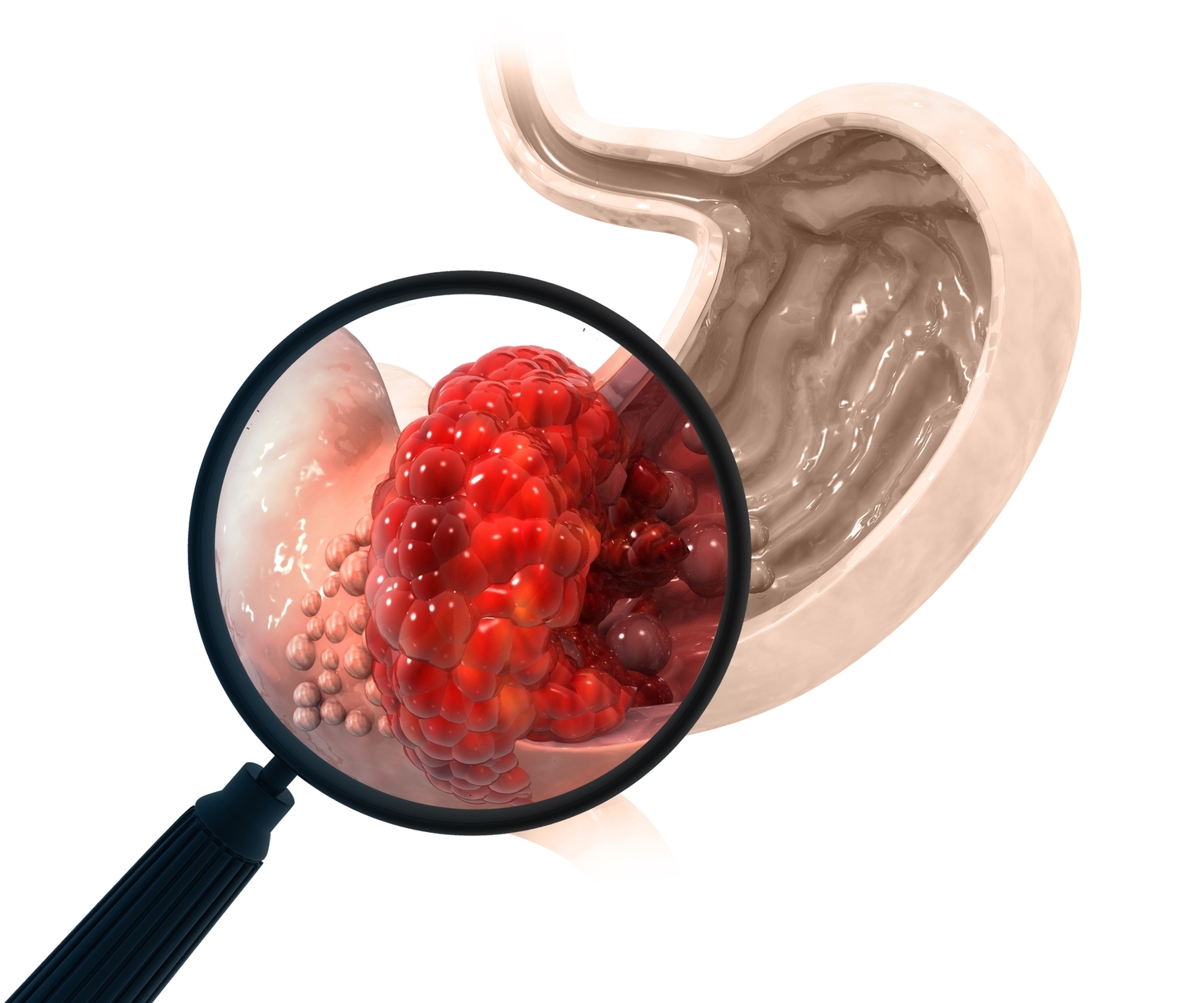 Innovative Therapies for Gastrointestinal Stromal Tumors: Ripretinib and Ayvakit