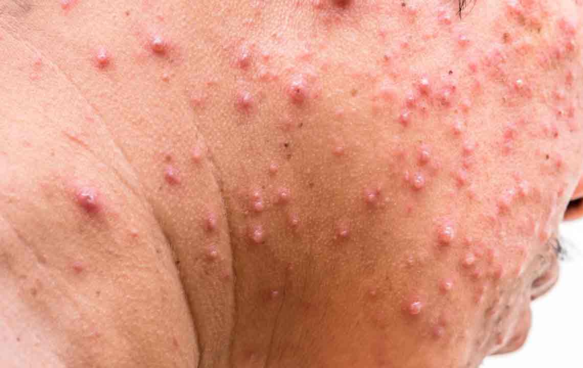 Effective Strategies for Managing and Treating Shingles Symptoms