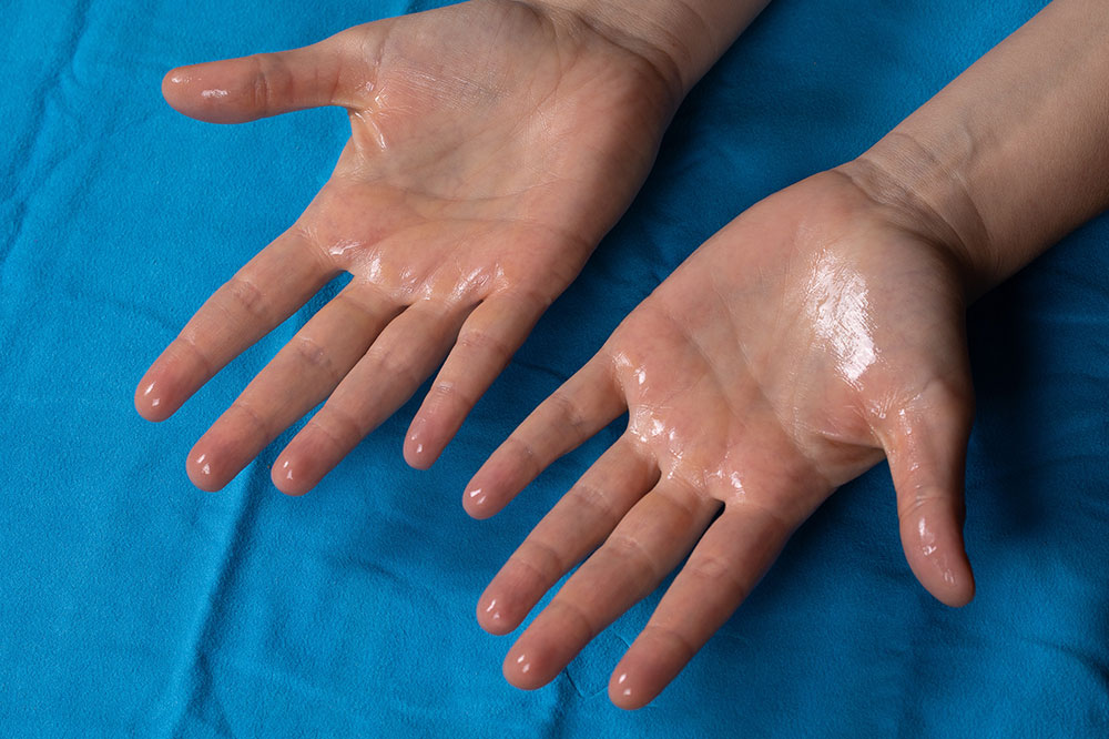 Top 5 Strategies for Managing Excessive Sweating