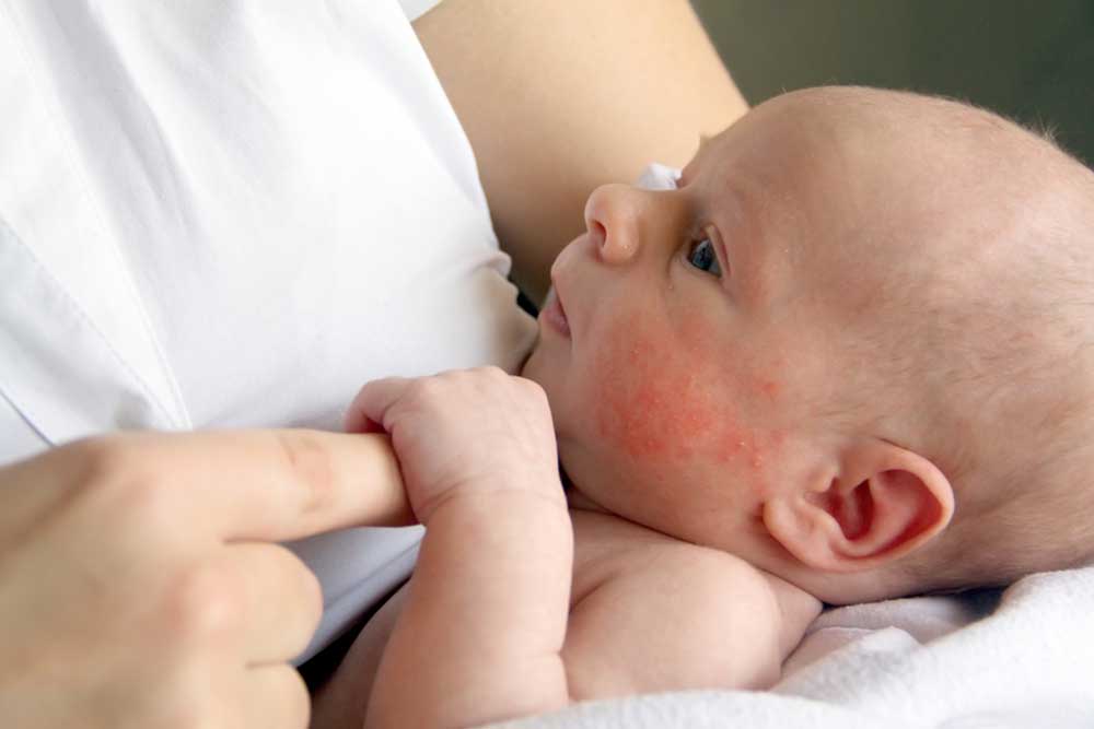 Effective Strategies to Treat Scabies Skin Rash