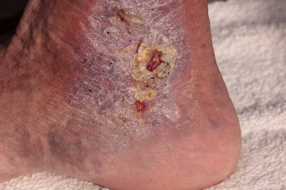 Understanding Cellulitis: Causes, Symptoms, and Prevention