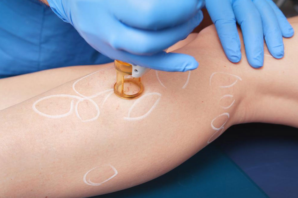 Essential Guide to Managing and Treating Leg Cellulitis