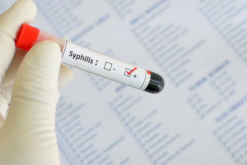 Understanding Syphilis: Early Symptoms and Detection Methods