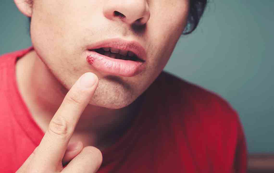Natural Solutions for Cold Sore Relief