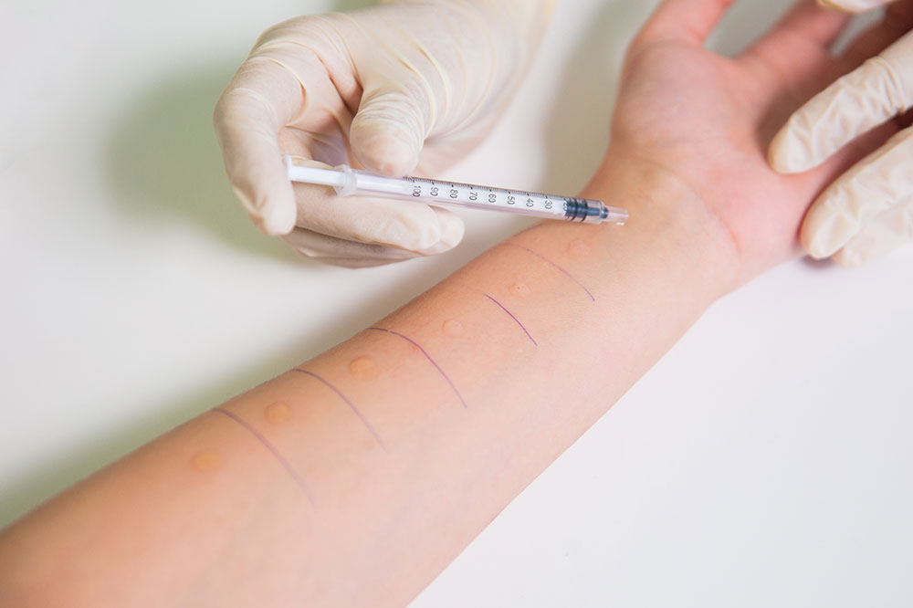 Comprehensive Guide to Detecting and Managing Allergies Effectively