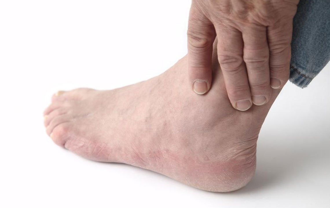Effective Home Remedies for Managing Gout Foot Discomfort
