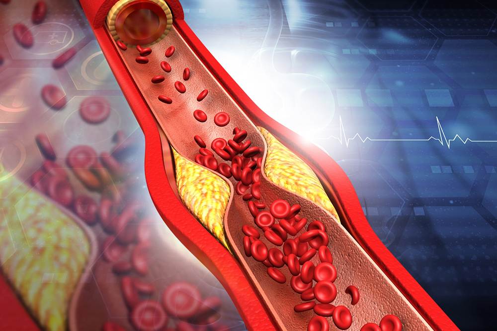 Comprehensive Approaches to Prevent and Reduce Arterial Plaque Bformation for Heart Health