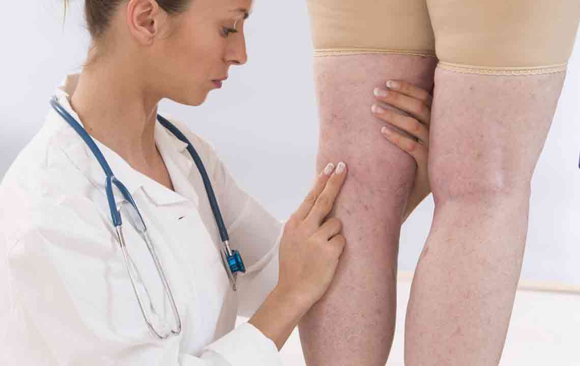 Recognizing the Key Symptoms and Risks of Deep Vein Thrombosis