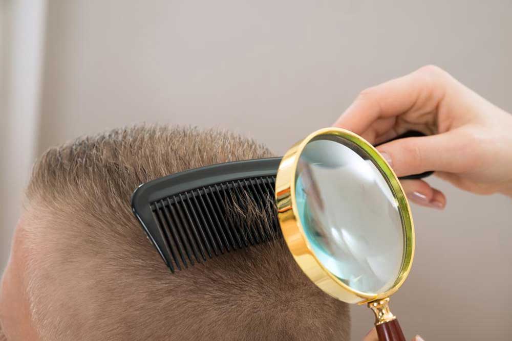 Understanding and Managing Seborrheic Dermatitis: Causes and Remedies