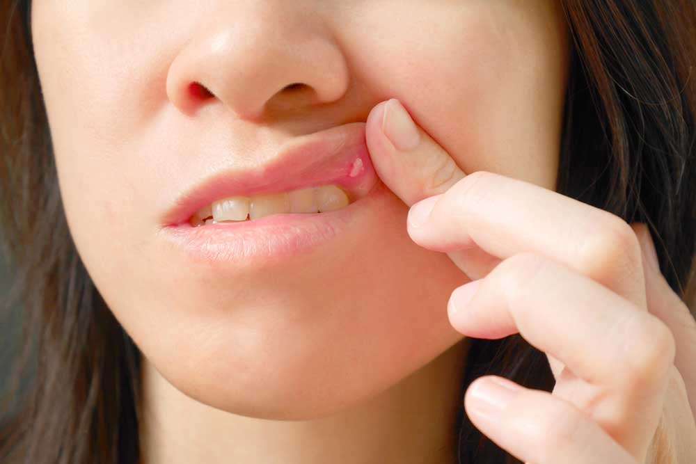 Understanding Common Causes of Mouth Sores