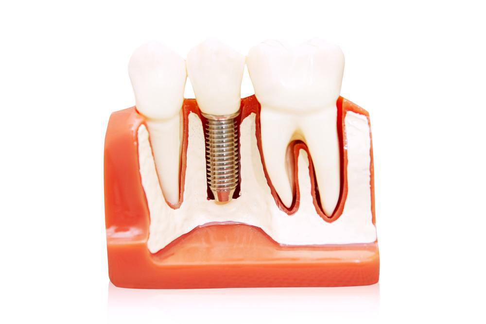 Comprehensive Guide to Fixed Dental Prostheses