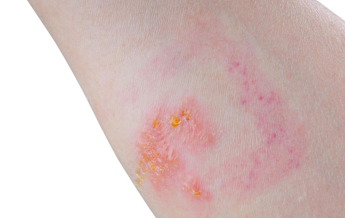 Comprehensive Home Remedies to Relieve and Heal Skin Rashes