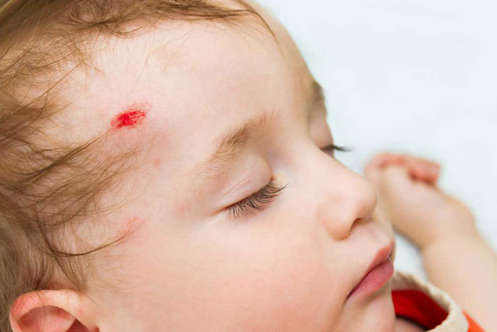 Signs and Symptoms of Head Injuries in Adults and Children