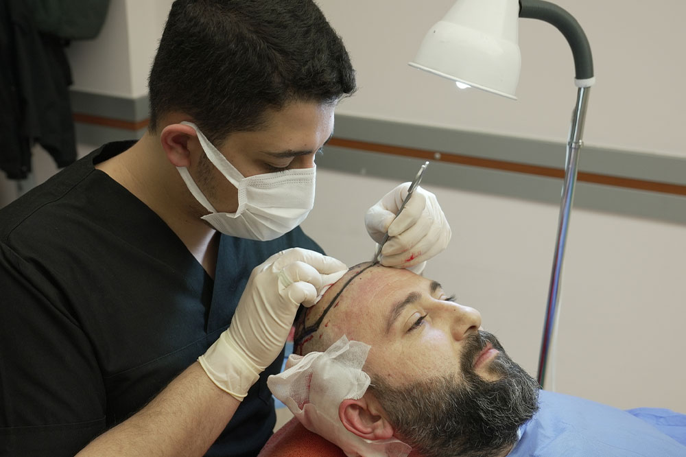 Comprehensive Guide to Hair Restoration in Turkey