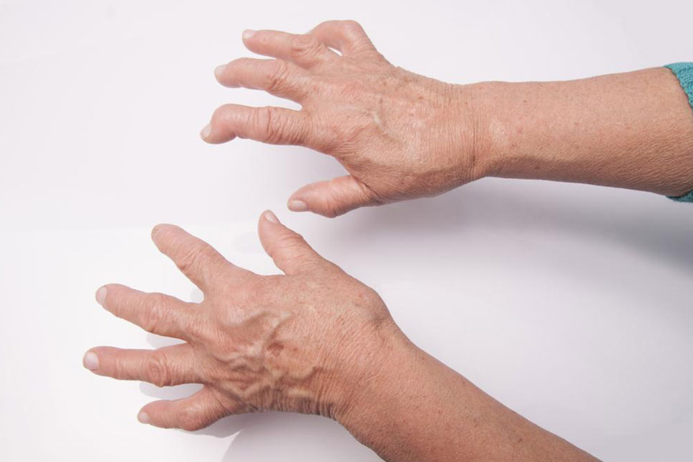 Essential Insights into Rheumatoid Arthritis and Systemic Lupus Erythematosus