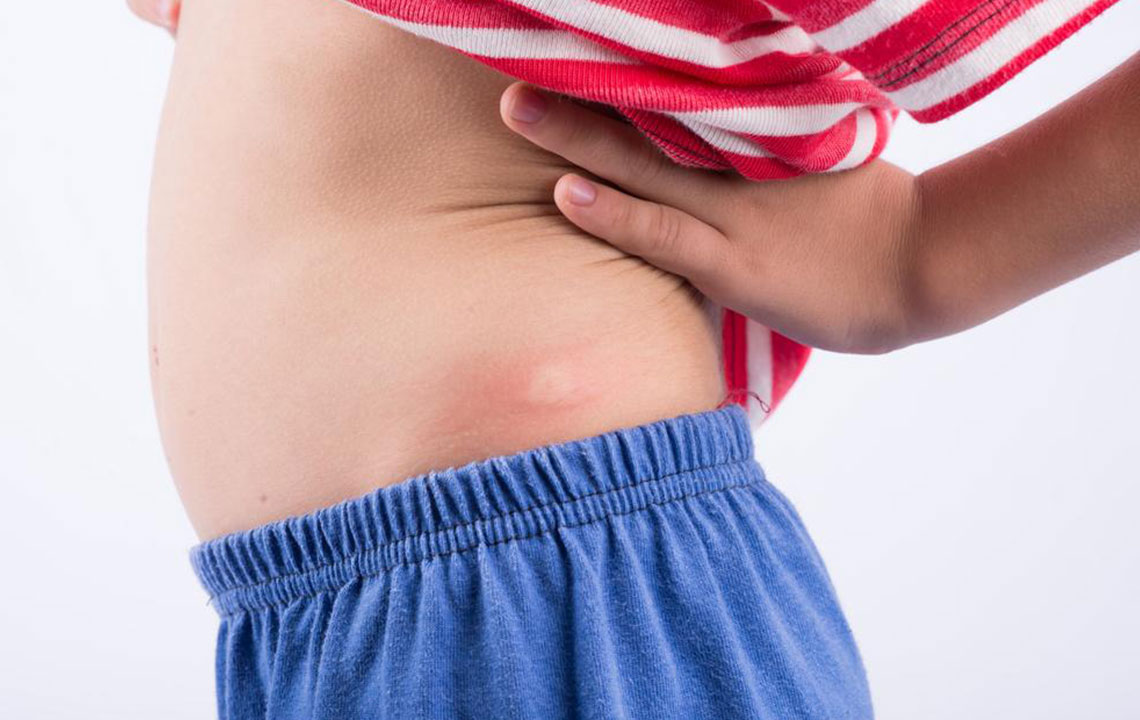 Essential Insights into Managing Hidradenitis Suppurativa
