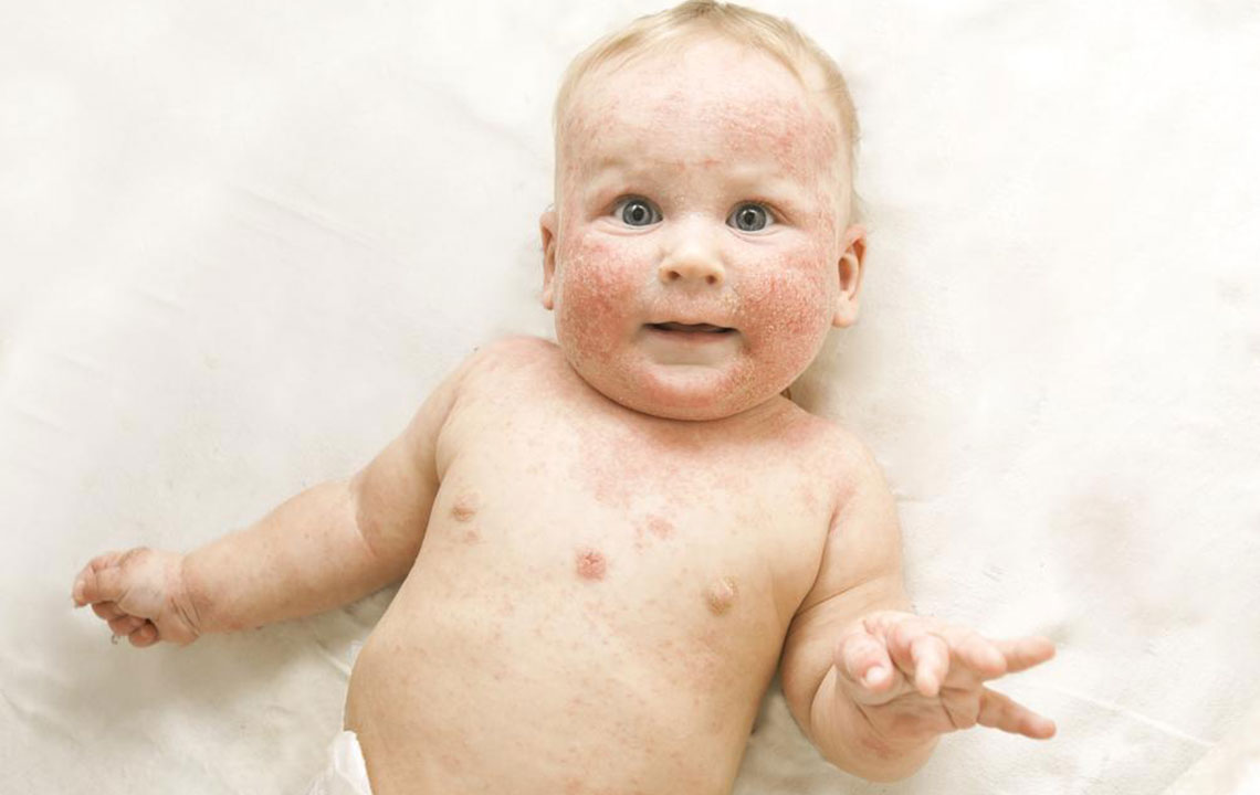 Comprehensive Strategies for Managing Atopic Dermatitis Symptoms Effectively