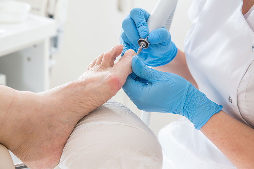 Using Listerine for Fungal Nail Infections: Benefits and Considerations