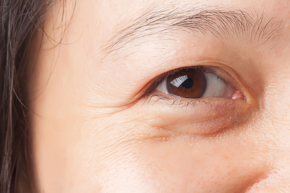 Understanding and Managing Under-Eye Bags