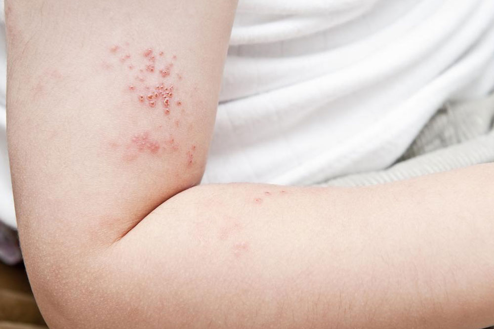 Overview of Common Viral Diseases and Their Types