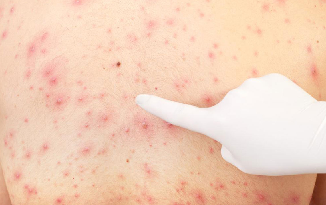 Comprehensive Guide to Managing Pityriasis Rosea