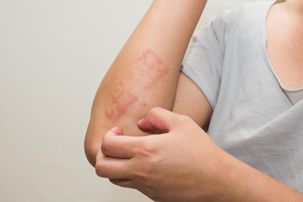 Effective Home Remedies for Poison Ivy Rash Identification and Relief