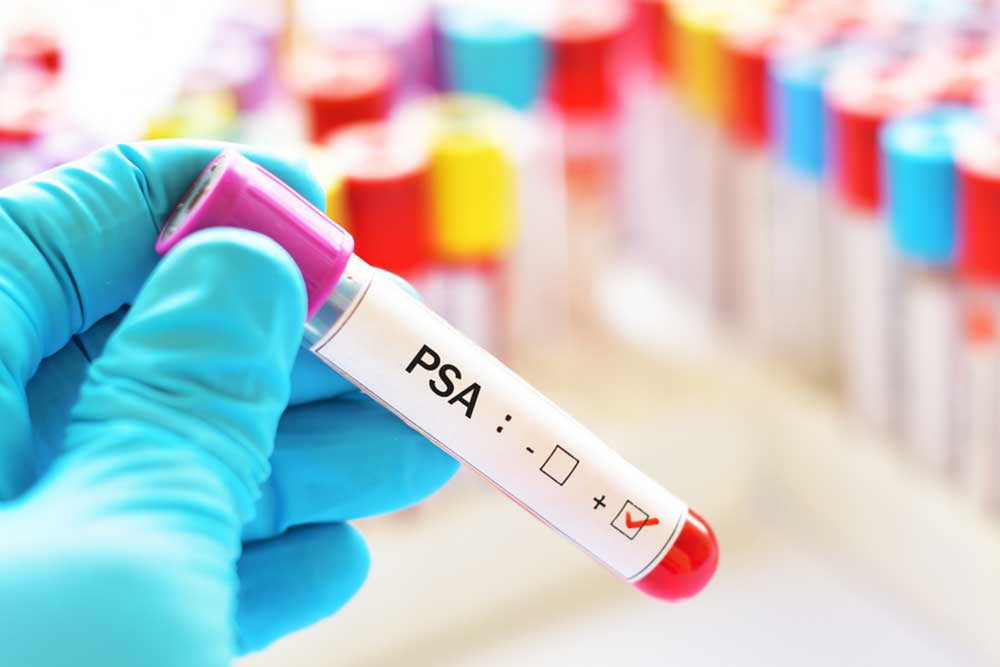 Understanding Normal PSA Levels Based on Age Factors