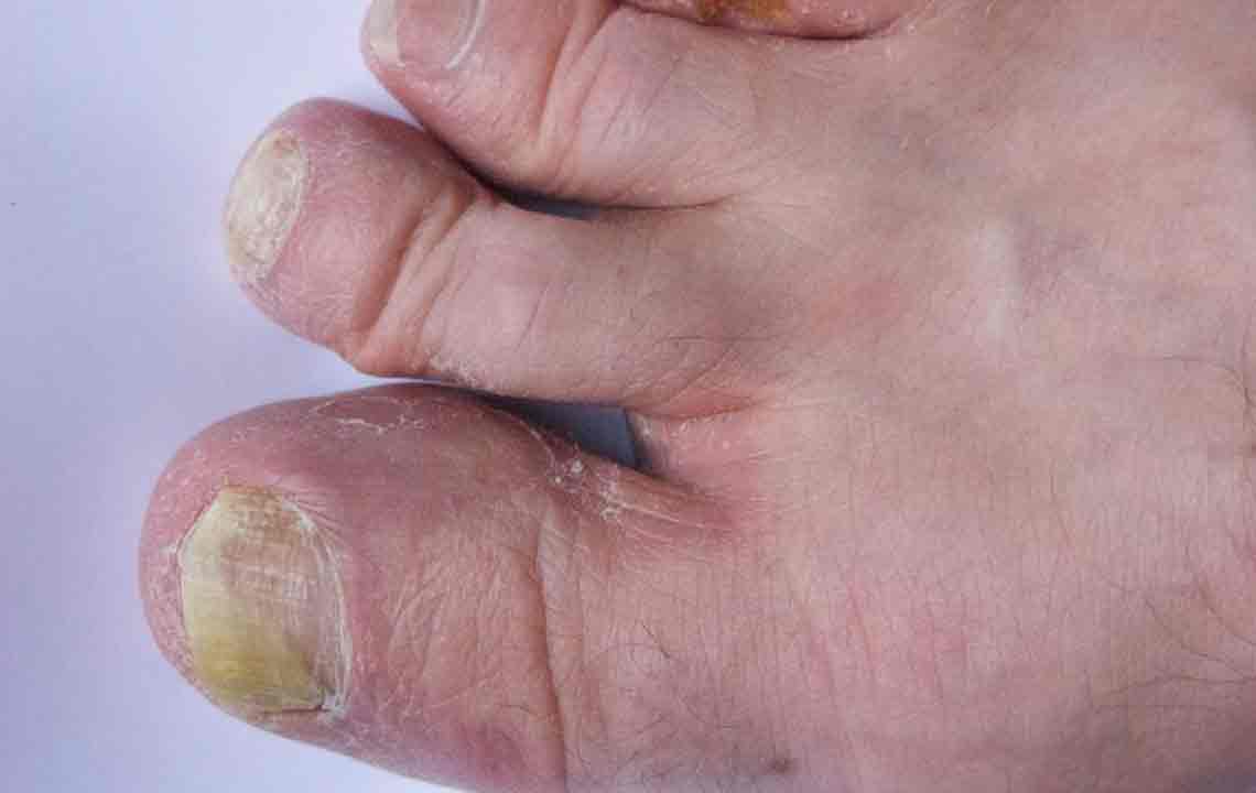 Natural Remedies for Toenail Fungal Infections: The Power of Listerine