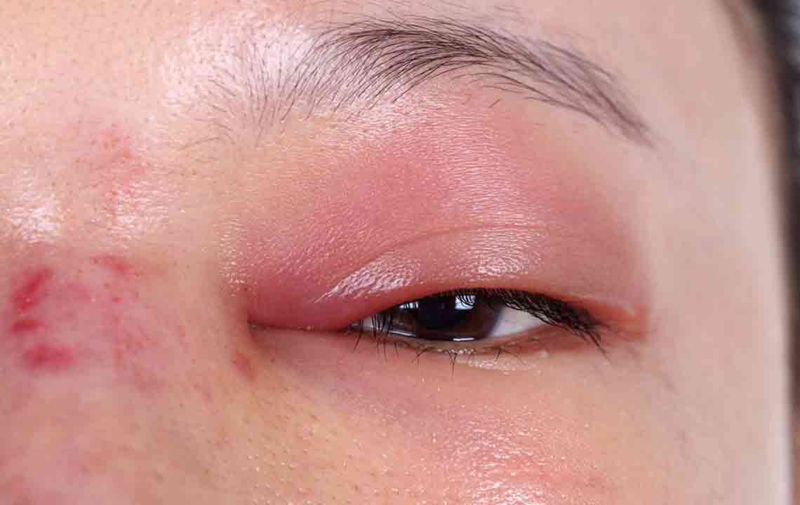 Effective Strategies to Reduce Under-Eye Swelling