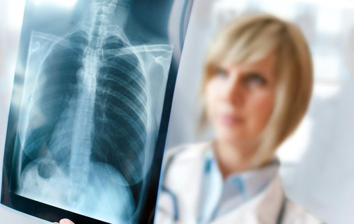 Understanding Lung Cancer Staging and Its Significance